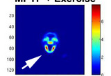 PET imaging of mouse striatum using 18-F fallypride ligand for dopamine D2 receptor. Mouse was lesioned with MPTP neurotoxin and exercised for 6 weeks prior to imaging.