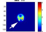 PET imaging of mouse striatum using 18-F fallypride ligand for dopamine D2 receptor. Mouse was lesioned with MPTP neurotoxin.