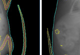 DEXA scans of wild-type (left) and leptin-deficient (right) mice (see 2010 Lasker Award).
Leptin is not only involved in body weight regulation, but also plays a key role, during both pre- and postnatal life, in the development of appetite-regulated pathways.