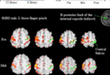 Neruorehabilitation and Neural Repair: Brain behavior correlates in Stroke Rehabilitation. Evolution of motor cortical activation, changes in the laterality index (LI) of primary motor cortex (M1) and mean Wolf Motor Function Test (mWMFT) across time in two patients, (A) and (B, see next research image). (A) Activation in the M1 became focused across time resulting from bilateral reduction in activation, but more so in contralesional (53 to 30 to 12 voxels) than in ipsilesional M1 (134 to 100 to 76 voxels). Consequently, there was a continuous increase in LI (from 0.43 to 0.53 to 0.73) associated with a substantial behavioral gain.