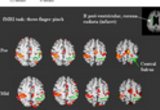 Neruorehabilitation and Neural Repair: Brain behavior correlates in Stroke Rehabilitation. Evolution of motor cortical activation, changes in the laterality index (LI) of primary motor cortex (M1) and mean Wolf Motor Function Test (mWMFT) across time in two patients, (A, see previous research image) and (B). (B) Patient 1 showed a significant decrease in LI of M1 from pre- (0.25) to mid- (0.6) intervention resulting from a reduction in ipsilesional M1 activation (from 72 to 55 voxels). The shift of LI toward the opposite direction midway through therapy correlated with minimal behavioral gain. For more information see Dong, et al, 2006.