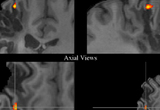 Northstar EVEREST Direct Cortical Stimulation Trial. Localization of anatomical activity for targeted subthreshold cortical stimulation in one patient with chronic stroke. Maximum activation in the stroke-affected hemisphere during four-finger movement task of the paretic limb. For patients randomized to neurosurgery, an investigational epidural electrode is centered over the fMRI-identified region of interest.