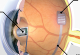 Intraocular retinal prosthesis with internally mounted (intraocular) camera, showing the intraocular camera, a multichip module package for conversion of camera signals to biological stimuli, an ultra-flexible ribbon cable, and a multielectrode array proximity coupled to the retina. The diagram is an illustration of a top view of the right eye, with the ultra-flexible ribbon cable routed in the opposite hemisphere for clarity of illustration.