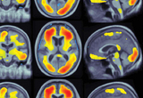 Obesity, Exercise, and Brain Aging