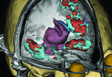 Lesion load mapping.