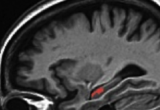Pilot data from an exercise intervention in older adults showing improved hippocampal function during a memory recognition task in the MRI scanner.
