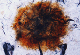 Double-immunolabeling with beta-amyloid (brown) and hyperphosphorylated tau PHF-1 (dark blue) shows amyloid plaques and neurofibrillary tangles, respectively, in an Alzheimer's brain.