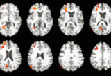 Magnitude and direction of voxel-level activation to a verbal-paired associate learning task superimposed onto axial slices of a representative image in Taliarach space (slices span from 19 inferior to 56 superior in 4mm increments). Activation displayed includes voxels significant at p < 0.025 that are contained within a cluster of 15 or more voxels (Han et al., 2007, Neurobiology of Aging).