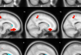 Functionally connected clusters associated with financial literacy after adjusting for age, education, sex, and global cognition, as indicated by a seed ROI prescribed in
the PCC. Seed ROI MNI coordinates: x = 0, y = -53, z = 26; radius = 4 mm; voxel p < 0.004. Corrected for multiple comparisons using AlphaSim Monte Carlo simulations at a
cluster level threshold of p < 0.0002 (cluster size > 75 voxels). Values shown in scale correspond to t-scores (Han et al., 2014, Archives of Geriatrics and Gerontology)