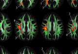 Voxelwise results of fractional anisotropy (FA) positive association with financial literacy in linear regression models adjusted for age, education, sex, white matter hyperintensities and cognitive function (Han et al., 2016, NeuroImage)