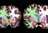 Structural segmentation of brain volumes in a child (yellow - nucleus accumbens; red - amygdala).