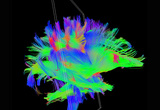 A designated coronal slice of white matter tracts using diffusion MRI and tractography in our laboratory