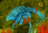 3D model of a human brain affected by traumatic brain injury (TBI). The cerebrum is translucent whilst the ventricles are blue. Areas affected by hemorrhage are drawn in red; they are surrounded by edematous areas (green). These models generated using multimodal neuroimaging allow one to quantify neuroanatomic pathology and to relate it to clinical outcome and deficits.