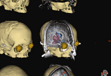 High-resolution finite element models (FEMs) of the brain affected by traumatic brain injury. These sophisticated models allow us to localize the electrical activity of the brain using electro- and magneto-encephalography (EEG and MEG), and thereby infer important information on the physiological changes prompted by brain injury.