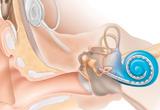 Cochlear Implant